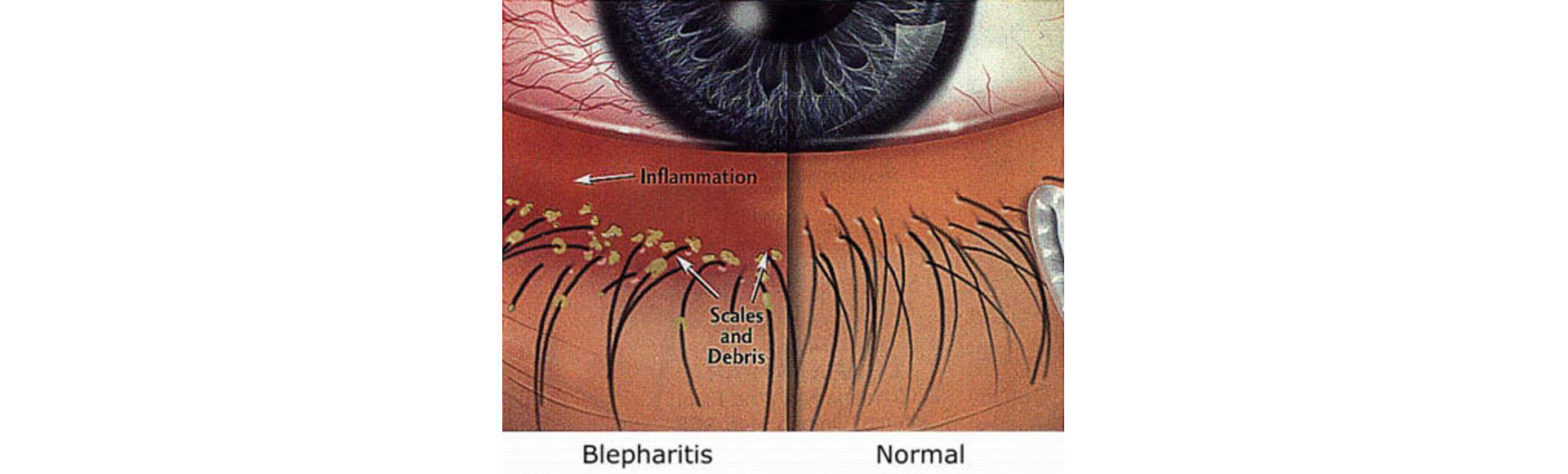 blepharitis