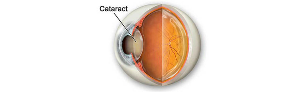 Cataract