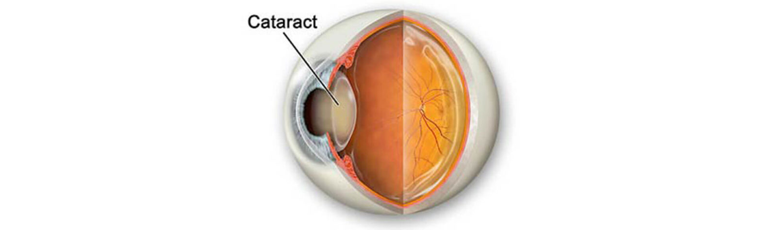 Cataract
