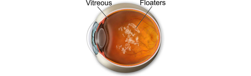 seeing-floaters-1