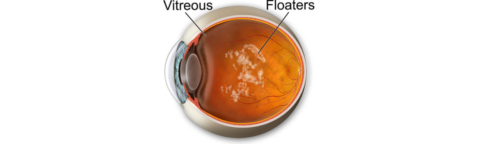 seeing-floaters-1