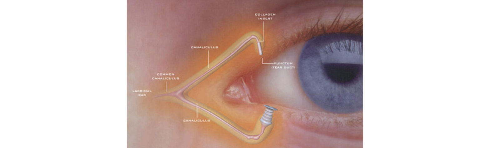 punctal-plugs-with-descriptions