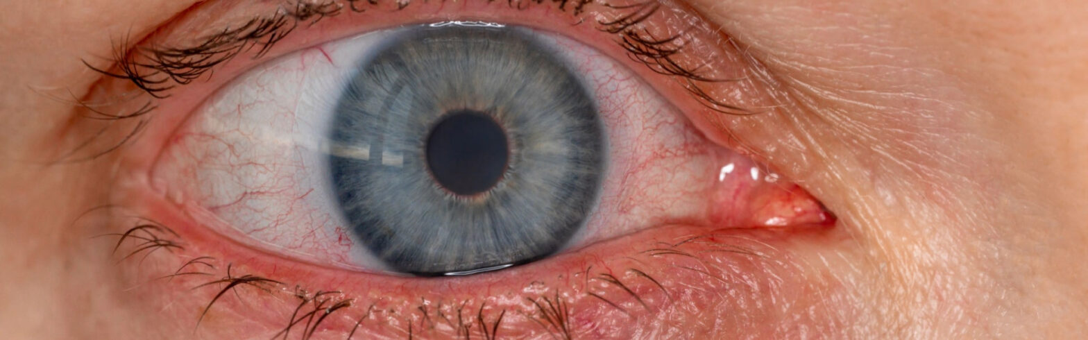 Effects Of Contact Lenses On Dry Eyes - Eyedeology