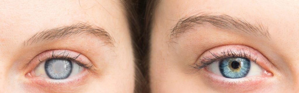Close-up of an eye showing cloudiness, illustrating early symptoms of cataracts